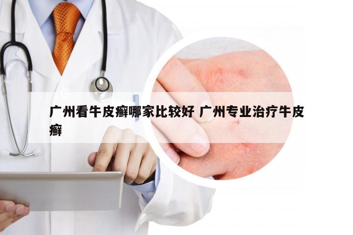 广州看牛皮癣哪家比较好 广州专业治疗牛皮癣