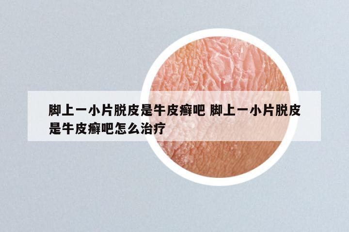 脚上一小片脱皮是牛皮癣吧 脚上一小片脱皮是牛皮癣吧怎么治疗