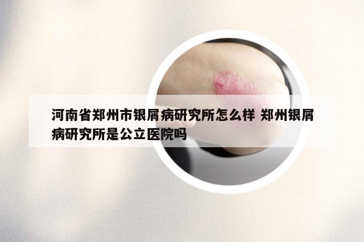河南省郑州市银屑病研究所怎么样 郑州银屑病研究所是公立医院吗