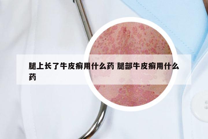 腿上长了牛皮癣用什么药 腿部牛皮癣用什么药