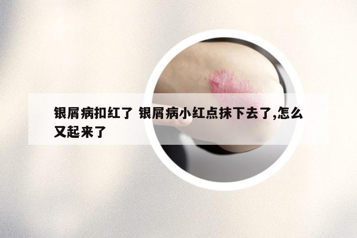 银屑病扣红了 银屑病小红点抹下去了,怎么又起来了