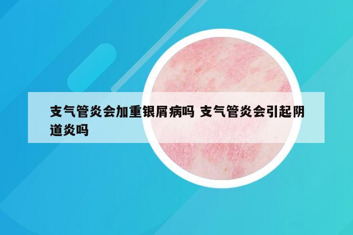 支气管炎会加重银屑病吗 支气管炎会引起阴道炎吗