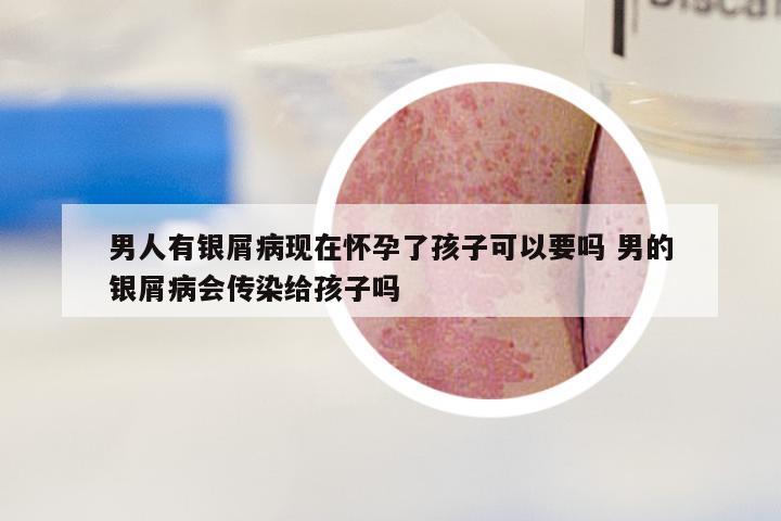 男人有银屑病现在怀孕了孩子可以要吗 男的银屑病会传染给孩子吗