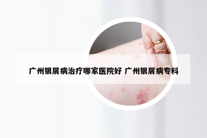 广州银屑病治疗哪家医院好 广州银屑病专科