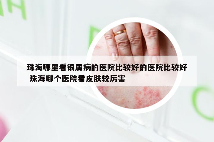 珠海哪里看银屑病的医院比较好的医院比较好 珠海哪个医院看皮肤较厉害
