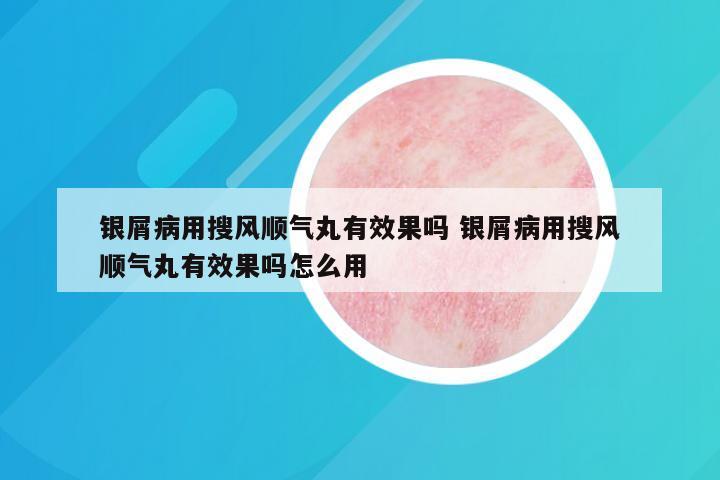 银屑病用搜风顺气丸有效果吗 银屑病用搜风顺气丸有效果吗怎么用
