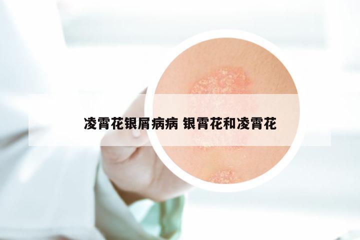 凌霄花银屑病病 银霄花和凌霄花