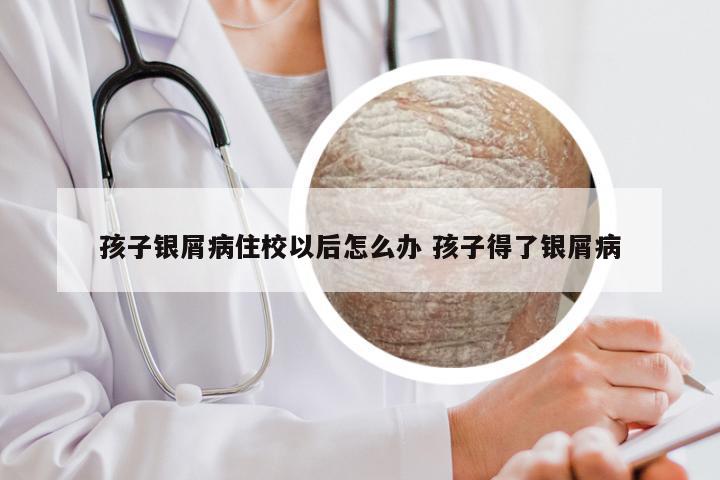 孩子银屑病住校以后怎么办 孩子得了银屑病