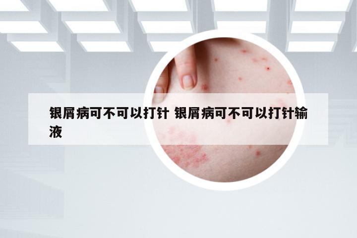 银屑病可不可以打针 银屑病可不可以打针输液