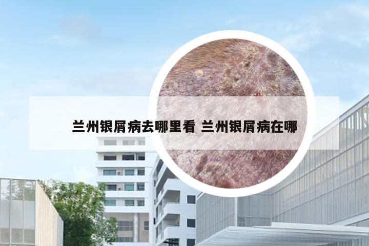 兰州银屑病去哪里看 兰州银屑病在哪