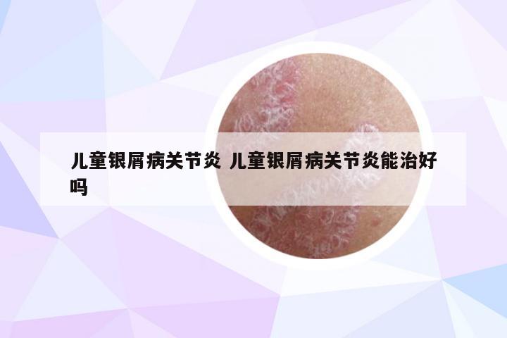 儿童银屑病关节炎 儿童银屑病关节炎能治好吗