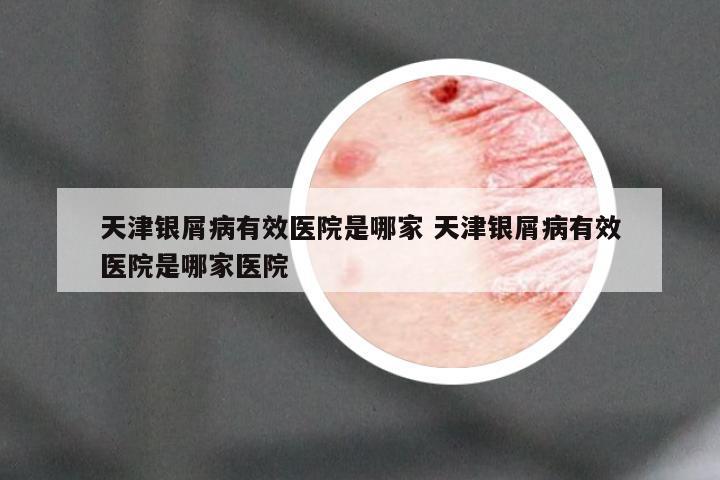 天津银屑病有效医院是哪家 天津银屑病有效医院是哪家医院