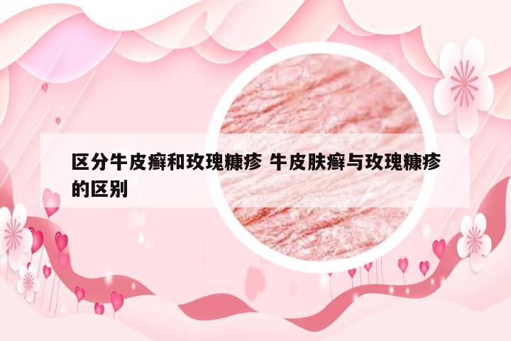 区分牛皮癣和玫瑰糠疹 牛皮肤癣与玫瑰糠疹的区别