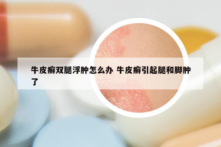 牛皮癣双腿浮肿怎么办 牛皮癣引起腿和脚肿了