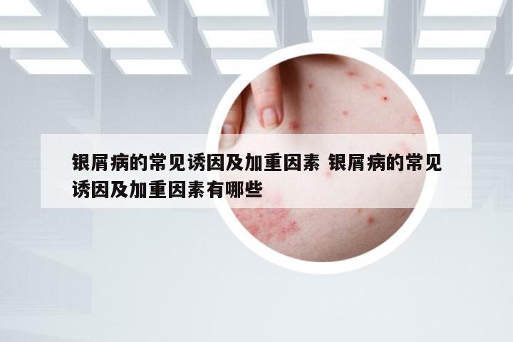 银屑病的常见诱因及加重因素 银屑病的常见诱因及加重因素有哪些