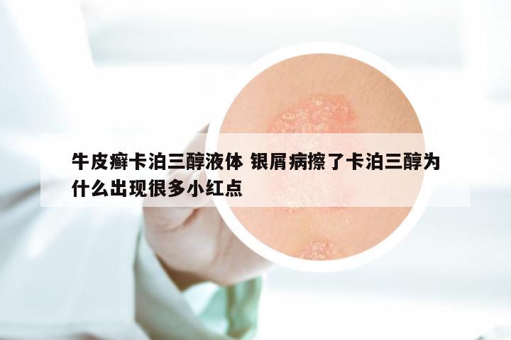 牛皮癣卡泊三醇液体 银屑病擦了卡泊三醇为什么出现很多小红点