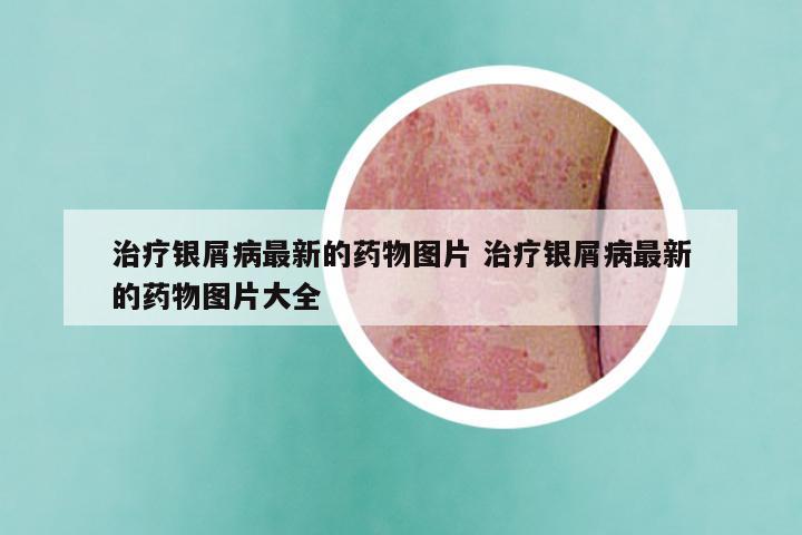 治疗银屑病最新的药物图片 治疗银屑病最新的药物图片大全
