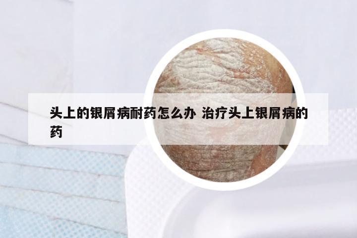 头上的银屑病耐药怎么办 治疗头上银屑病的药