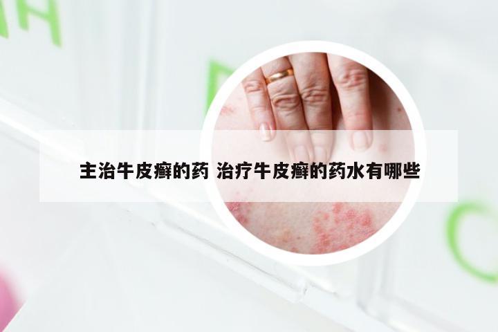 主治牛皮癣的药 治疗牛皮癣的药水有哪些
