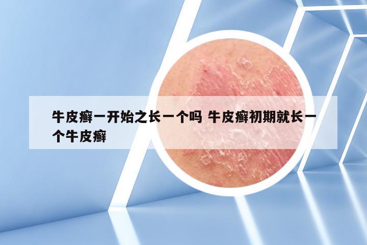 牛皮癣一开始之长一个吗 牛皮癣初期就长一个牛皮癣