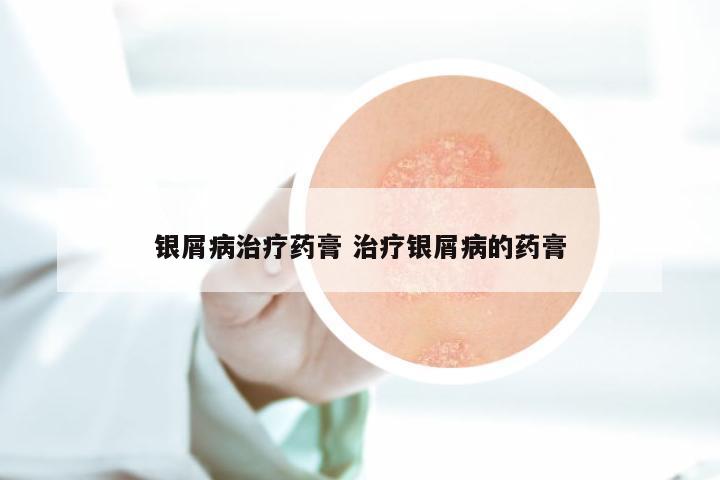 银屑病治疗药膏 治疗银屑病的药膏
