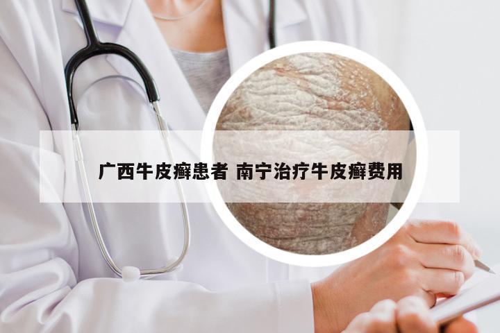 广西牛皮癣患者 南宁治疗牛皮癣费用