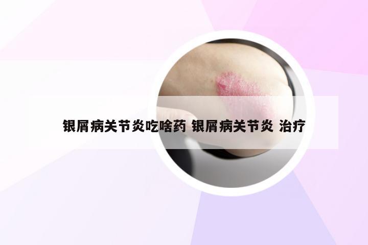 银屑病关节炎吃啥药 银屑病关节炎 治疗