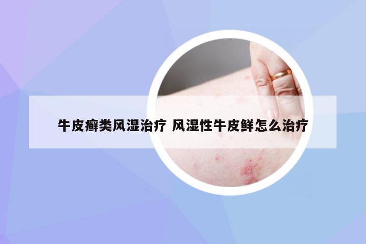 牛皮癣类风湿治疗 风湿性牛皮鲜怎么治疗