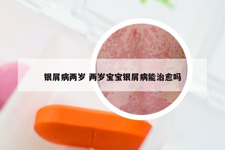 银屑病两岁 两岁宝宝银屑病能治愈吗
