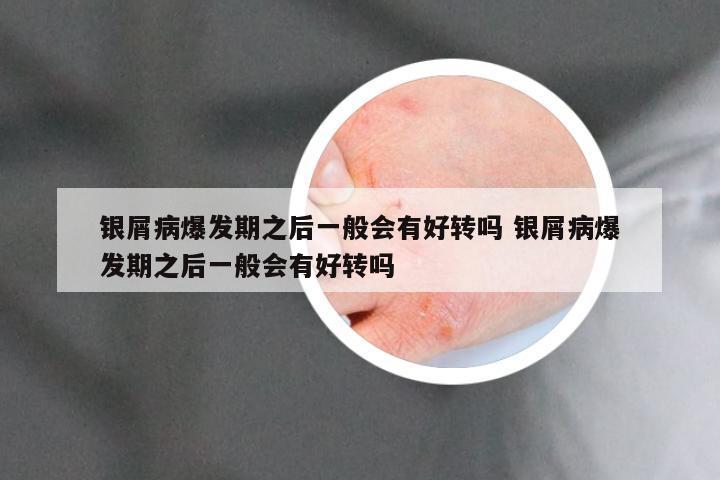 银屑病爆发期之后一般会有好转吗 银屑病爆发期之后一般会有好转吗