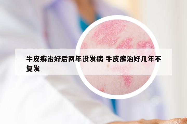 牛皮癣治好后两年没发病 牛皮癣治好几年不复发