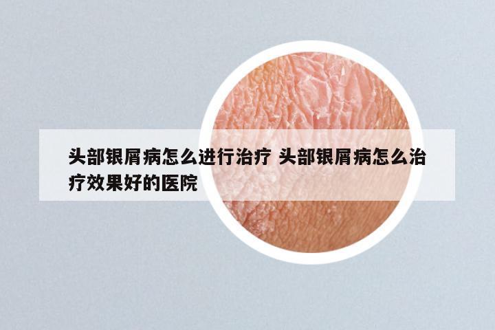 头部银屑病怎么进行治疗 头部银屑病怎么治疗效果好的医院