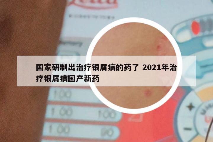 国家研制出治疗银屑病的药了 2021年治疗银屑病国产新药
