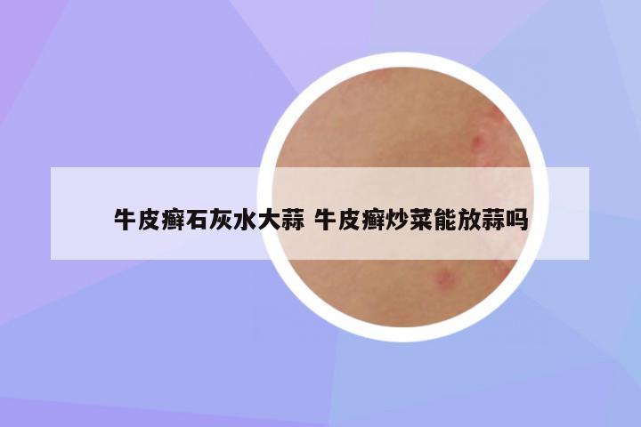 牛皮癣石灰水大蒜 牛皮癣炒菜能放蒜吗