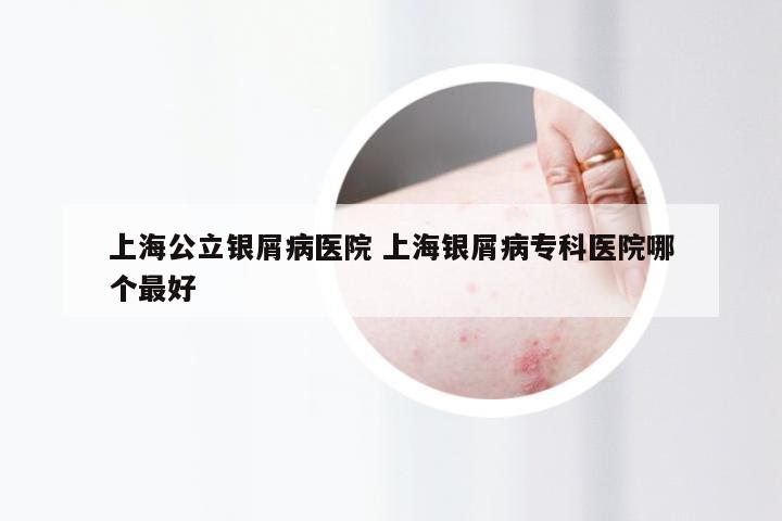 上海公立银屑病医院 上海银屑病专科医院哪个最好