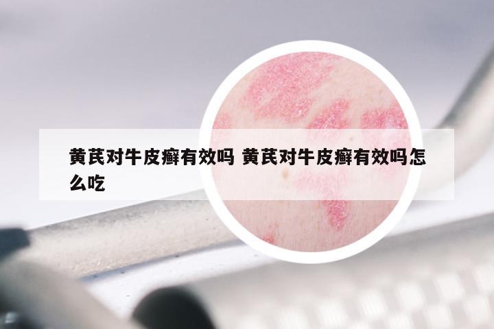 黄芪对牛皮癣有效吗 黄芪对牛皮癣有效吗怎么吃