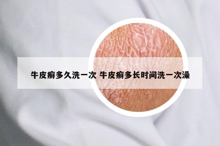 牛皮癣多久洗一次 牛皮癣多长时间洗一次澡