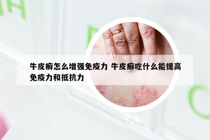 牛皮癣怎么增强免疫力 牛皮癣吃什么能提高免疫力和抵抗力
