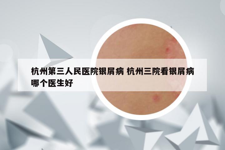 杭州第三人民医院银屑病 杭州三院看银屑病哪个医生好