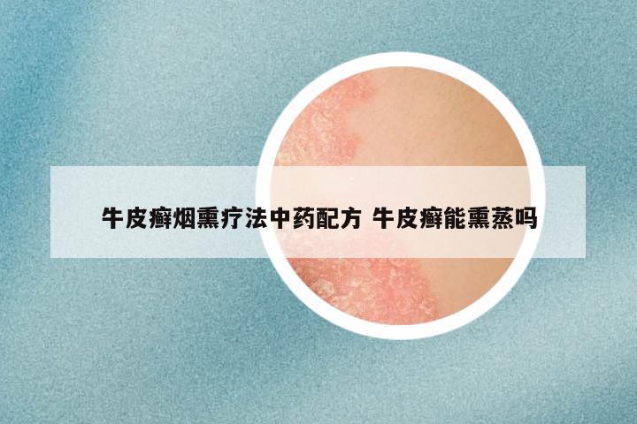 牛皮癣烟熏疗法中药配方 牛皮癣能熏蒸吗