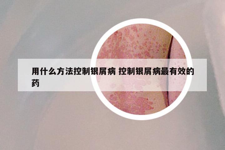 用什么方法控制银屑病 控制银屑病最有效的药