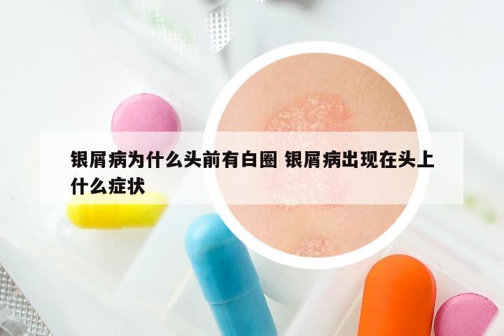 银屑病为什么头前有白圈 银屑病出现在头上什么症状