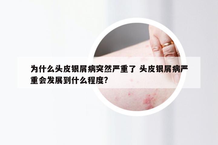 为什么头皮银屑病突然严重了 头皮银屑病严重会发展到什么程度?