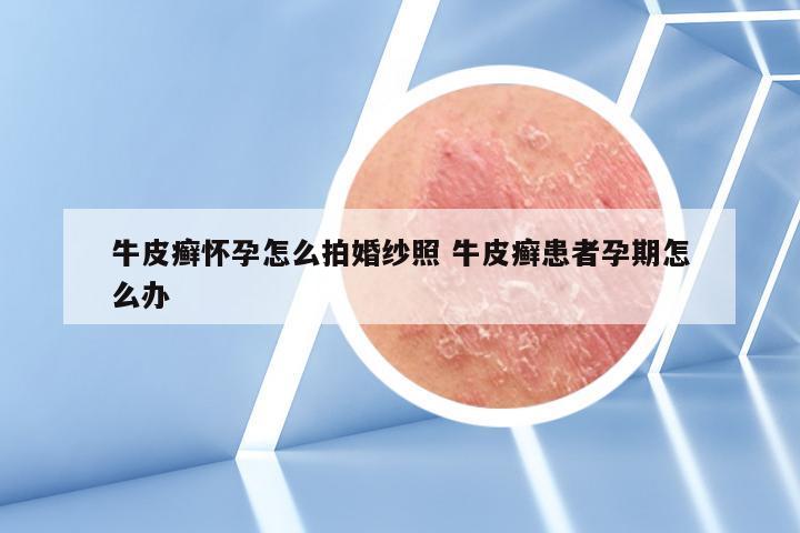 牛皮癣怀孕怎么拍婚纱照 牛皮癣患者孕期怎么办