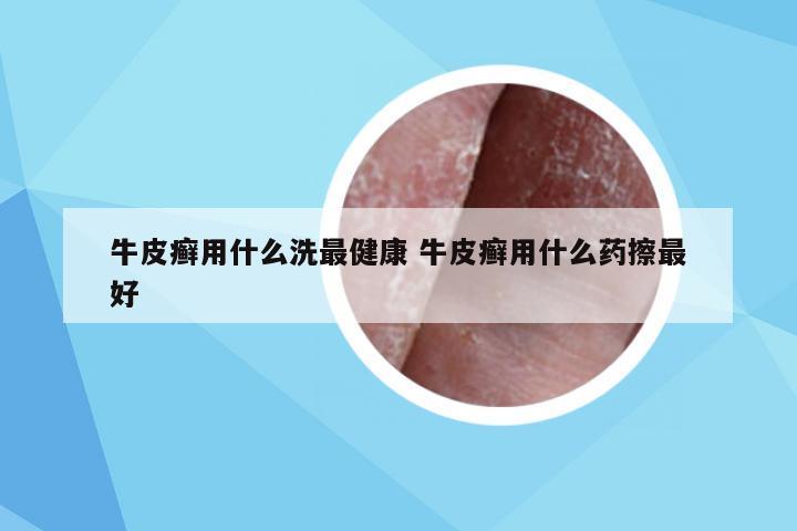 牛皮癣用什么洗最健康 牛皮癣用什么药擦最好