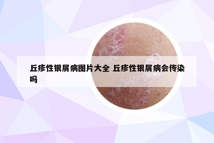 丘疹性银屑病图片大全 丘疹性银屑病会传染吗