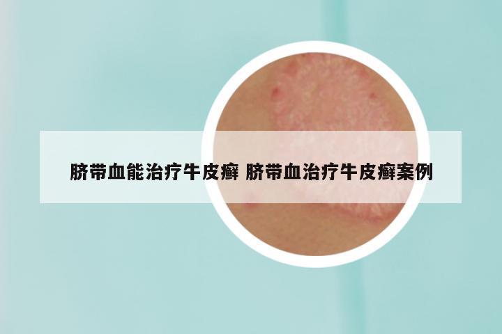 脐带血能治疗牛皮癣 脐带血治疗牛皮癣案例