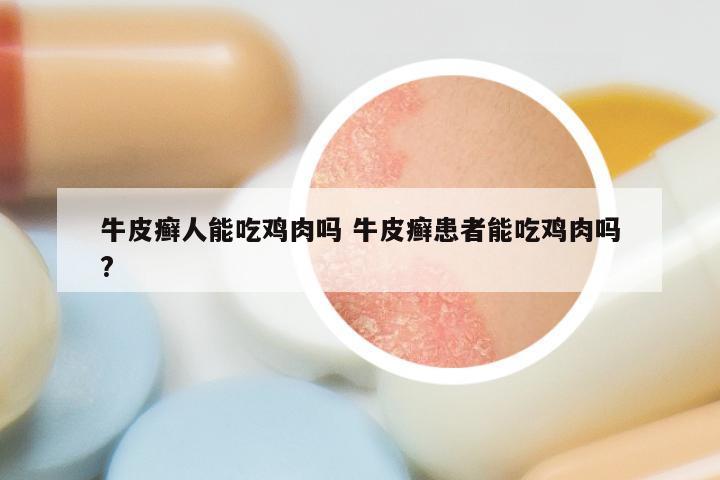 牛皮癣人能吃鸡肉吗 牛皮癣患者能吃鸡肉吗?
