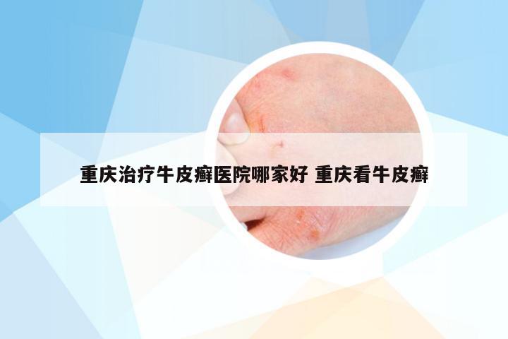 重庆治疗牛皮癣医院哪家好 重庆看牛皮癣