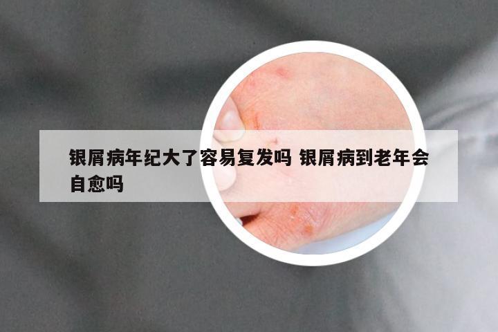 银屑病年纪大了容易复发吗 银屑病到老年会自愈吗
